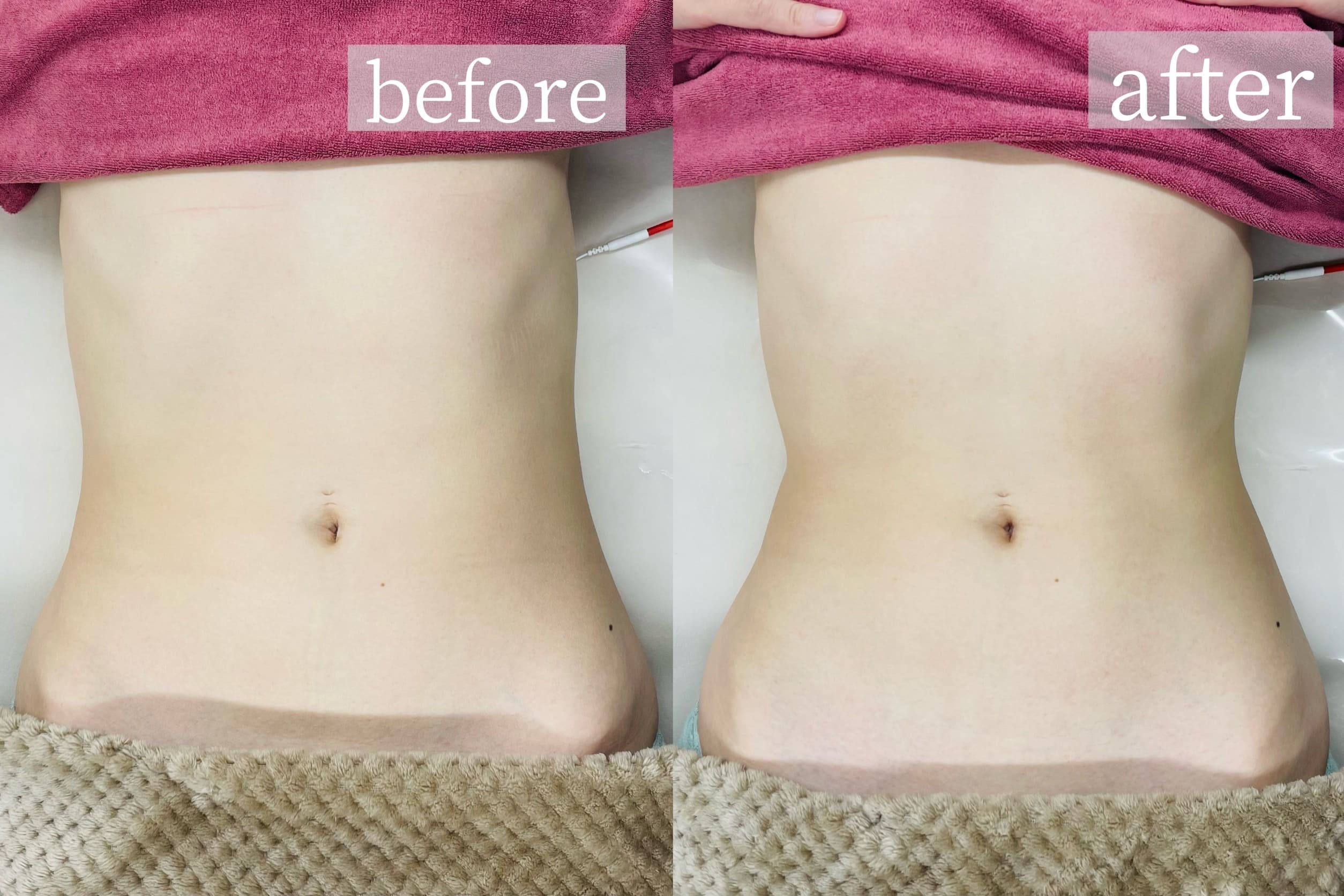 痩身（腹部）症例写真